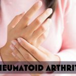 RHEUMATOID ARTHRITIS